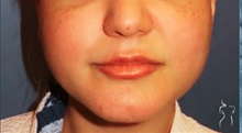 Cheek Reduction Before Photo by Kristopher Day, MD, FACS; Bellevue, WA - Case 49886 Cheek Reduction Before Photo by Kristopher Day, MD, FACS; Bellevue, WA - Case 49886