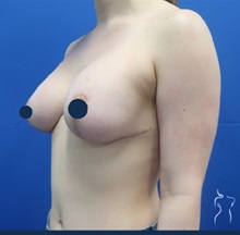 Breast Augmentation After Photo by Kristopher Day, MD, FACS; Bellevue, WA - Case 49889