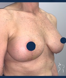 Breast Lift After Photo by Kristopher Day, MD, FACS; Bellevue, WA - Case 49891 Breast Lift After Photo by Kristopher Day, MD, FACS; Bellevue, WA - Case 49891