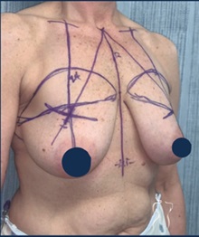 Breast Lift Before Photo by Kristopher Day, MD, FACS; Bellevue, WA - Case 49891 Breast Lift Before Photo by Kristopher Day, MD, FACS; Bellevue, WA - Case 49891