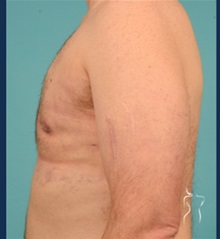 Body Contouring After Photo by Kristopher Day, MD, FACS; Bellevue, WA - Case 49890 Body Contouring After Photo by Kristopher Day, MD, FACS; Bellevue, WA - Case 49890