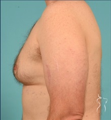Body Contouring Before Photo by Kristopher Day, MD, FACS; Bellevue, WA - Case 49890 Body Contouring Before Photo by Kristopher Day, MD, FACS; Bellevue, WA - Case 49890