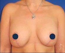 Breast Augmentation After Photo by Kristopher Day, MD, FACS; Bellevue, WA - Case 49894
