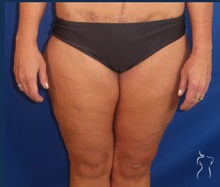 Thigh Lift After Photo by Kristopher Day, MD, FACS; Bellevue, WA - Case 49896 Thigh Lift After Photo by Kristopher Day, MD, FACS; Bellevue, WA - Case 49896