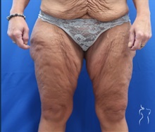 Thigh Lift Before Photo by Kristopher Day, MD, FACS; Bellevue, WA - Case 49896 Thigh Lift Before Photo by Kristopher Day, MD, FACS; Bellevue, WA - Case 49896