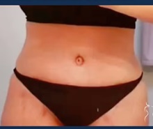 Tummy Tuck After Photo by Kristopher Day, MD, FACS; Bellevue, WA - Case 49903