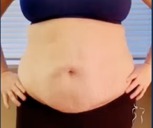 Tummy Tuck Before Photo by Kristopher Day, MD, FACS; Bellevue, WA - Case 49903