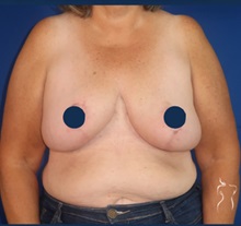 Breast Reduction After Photo by Kristopher Day, MD, FACS; Bellevue, WA - Case 49904 Breast Reduction After Photo by Kristopher Day, MD, FACS; Bellevue, WA - Case 49904
