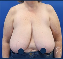 Breast Reduction Before Photo by Kristopher Day, MD, FACS; Bellevue, WA - Case 49904 Breast Reduction Before Photo by Kristopher Day, MD, FACS; Bellevue, WA - Case 49904