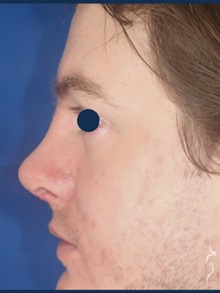 Rhinoplasty After Photo by Kristopher Day, MD, FACS; Bellevue, WA - Case 49906 Rhinoplasty After Photo by Kristopher Day, MD, FACS; Bellevue, WA - Case 49906