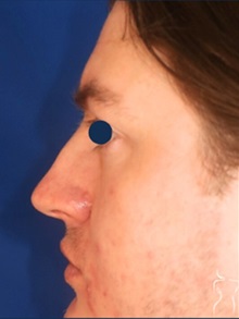 Rhinoplasty Before Photo by Kristopher Day, MD, FACS; Bellevue, WA - Case 49906 Rhinoplasty Before Photo by Kristopher Day, MD, FACS; Bellevue, WA - Case 49906