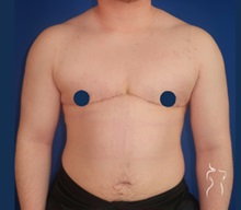 Body Masculinization After Photo by Kristopher Day, MD, FACS; Bellevue, WA - Case 49900 Body Masculinization After Photo by Kristopher Day, MD, FACS; Bellevue, WA - Case 49900