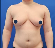 Body Masculinization Before Photo by Kristopher Day, MD, FACS; Bellevue, WA - Case 49900 Body Masculinization Before Photo by Kristopher Day, MD, FACS; Bellevue, WA - Case 49900