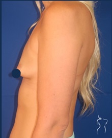Breast Augmentation Before Photo by Kristopher Day, MD, FACS; Bellevue, WA - Case 49905