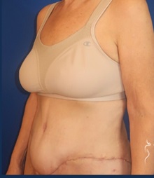 Tummy Tuck After Photo by Kristopher Day, MD, FACS; Bellevue, WA - Case 49907