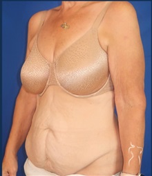 Tummy Tuck Before Photo by Kristopher Day, MD, FACS; Bellevue, WA - Case 49907