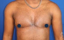 Body Masculinization After Photo by Kristopher Day, MD, FACS; Bellevue, WA - Case 49901 Body Masculinization After Photo by Kristopher Day, MD, FACS; Bellevue, WA - Case 49901