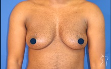 Body Masculinization Before Photo by Kristopher Day, MD, FACS; Bellevue, WA - Case 49901 Body Masculinization Before Photo by Kristopher Day, MD, FACS; Bellevue, WA - Case 49901