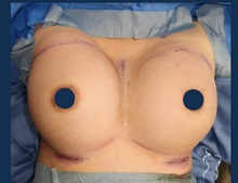 Breast Augmentation After Photo by Kristopher Day, MD, FACS; Bellevue, WA - Case 49902