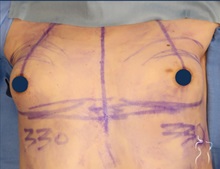 Breast Augmentation Before Photo by Kristopher Day, MD, FACS; Bellevue, WA - Case 49902