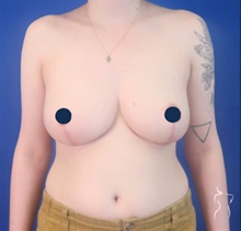 Breast Reduction After Photo by Kristopher Day, MD, FACS; Bellevue, WA - Case 49908 Breast Reduction After Photo by Kristopher Day, MD, FACS; Bellevue, WA - Case 49908