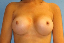 Breast Augmentation After Photo by Caleb Steffen, MD; Jefferson City, MO - Case 47855