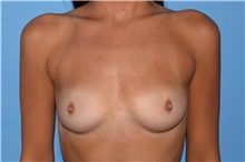 Breast Augmentation Before Photo by Caleb Steffen, MD; Jefferson City, MO - Case 47855