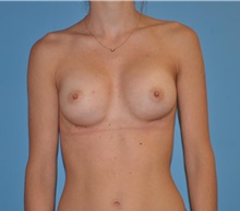 Breast Augmentation After Photo by Caleb Steffen, MD; Jefferson City, MO - Case 47857