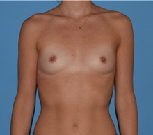 Breast Augmentation Before Photo by Caleb Steffen, MD; Jefferson City, MO - Case 47857