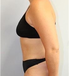 Tummy Tuck After Photo by Caleb Steffen, MD; Jefferson City, MO - Case 47859