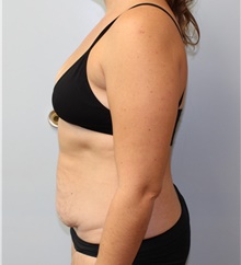 Tummy Tuck Before Photo by Caleb Steffen, MD; Jefferson City, MO - Case 47859