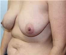 Breast Reconstruction Before Photo by Caleb Steffen, MD; Jefferson City, MO - Case 47860
