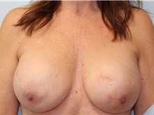 Breast Reconstruction After Photo by Caleb Steffen, MD; Jefferson City, MO - Case 47861