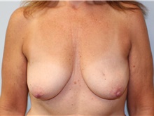 Breast Reconstruction Before Photo by Caleb Steffen, MD; Jefferson City, MO - Case 47861