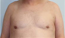 Liposuction After Photo by Caleb Steffen, MD; Jefferson City, MO - Case 47864