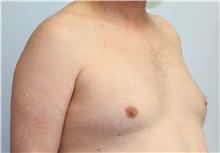 Liposuction Before Photo by Caleb Steffen, MD; Jefferson City, MO - Case 47864