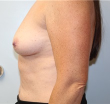 Breast Augmentation Before Photo by Caleb Steffen, MD; ,  - Case 50389