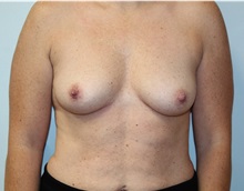 Breast Augmentation Before Photo by Caleb Steffen, MD; ,  - Case 50389