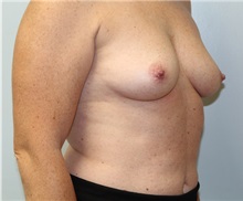 Breast Augmentation Before Photo by Caleb Steffen, MD; ,  - Case 50389