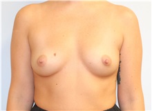 Breast Augmentation Before Photo by Caleb Steffen, MD; ,  - Case 50390