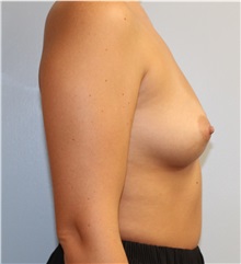 Breast Augmentation Before Photo by Caleb Steffen, MD; ,  - Case 50390