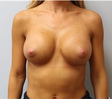Breast Augmentation After Photo by Caleb Steffen, MD; Jefferson City, MO - Case 50143