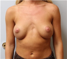 Breast Augmentation Before Photo by Caleb Steffen, MD; Jefferson City, MO - Case 50143