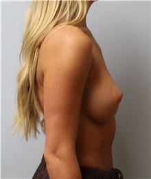 Breast Augmentation Before Photo by Caleb Steffen, MD; Jefferson City, MO - Case 50143