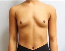 Breast Augmentation Before Photo by Caleb Steffen, MD; Jefferson City, MO - Case 50144 Breast Augmentation Before Photo by Caleb Steffen, MD; Jefferson City, MO - Case 50144