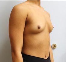Breast Augmentation Before Photo by Caleb Steffen, MD; Jefferson City, MO - Case 50144
