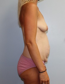 Tummy Tuck Before Photo by Caleb Steffen, MD; Jefferson City, MO - Case 50145