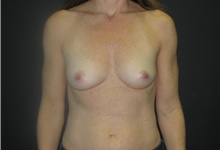 Breast Reconstruction Before Photo by C. Andrew Salzberg, MD; Vero Beach, FL - Case 39361