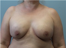 Breast Reconstruction After Photo by C. Andrew Salzberg, MD; Vero Beach, FL - Case 39565