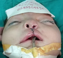Cleft Lip and Palate Repair After Photo by Tarek Elbanoby, MD; Cairo,  - Case 33580